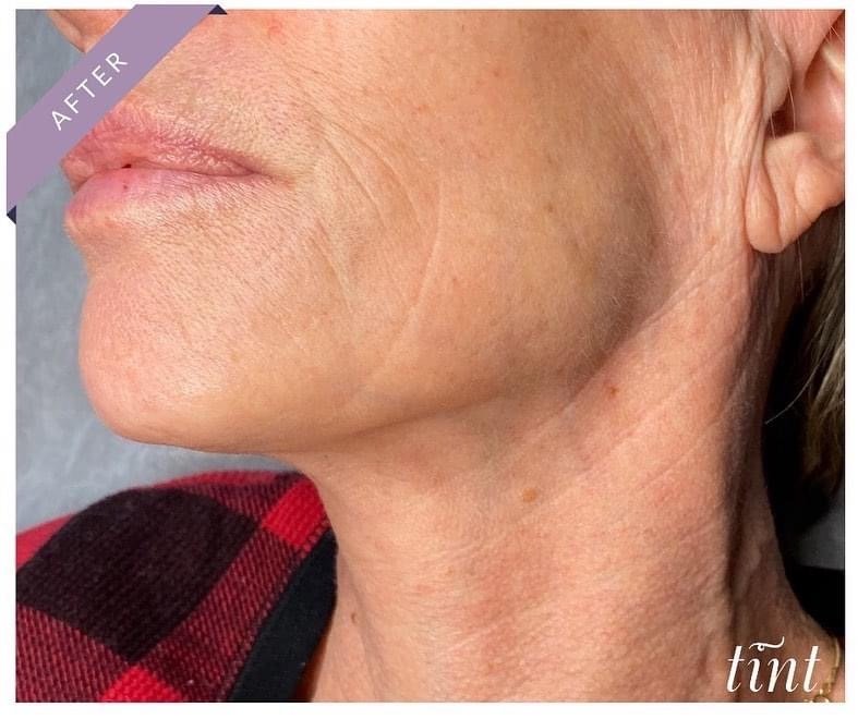 Maine Plasma Skin Tightening