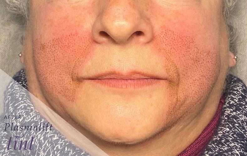 Plasma Lift Skin Tightening