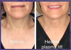 before and after plasma lift skin tightening